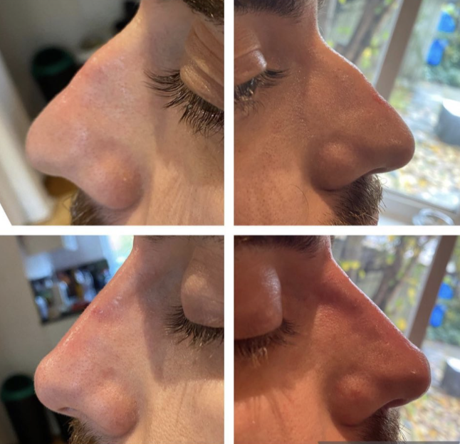 Non-surgical rhinoplasty result 2
