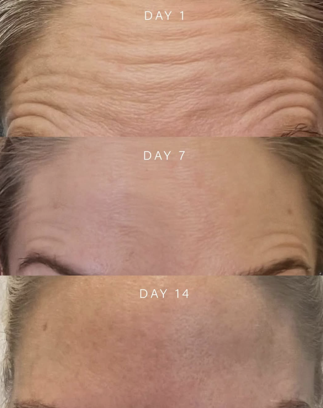Anti-wrinkle treatment result