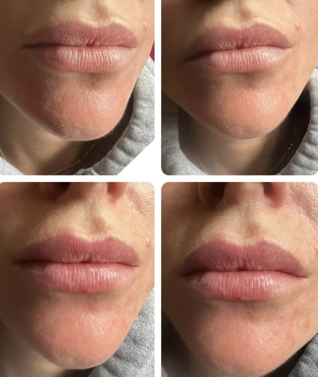 Lip filler result