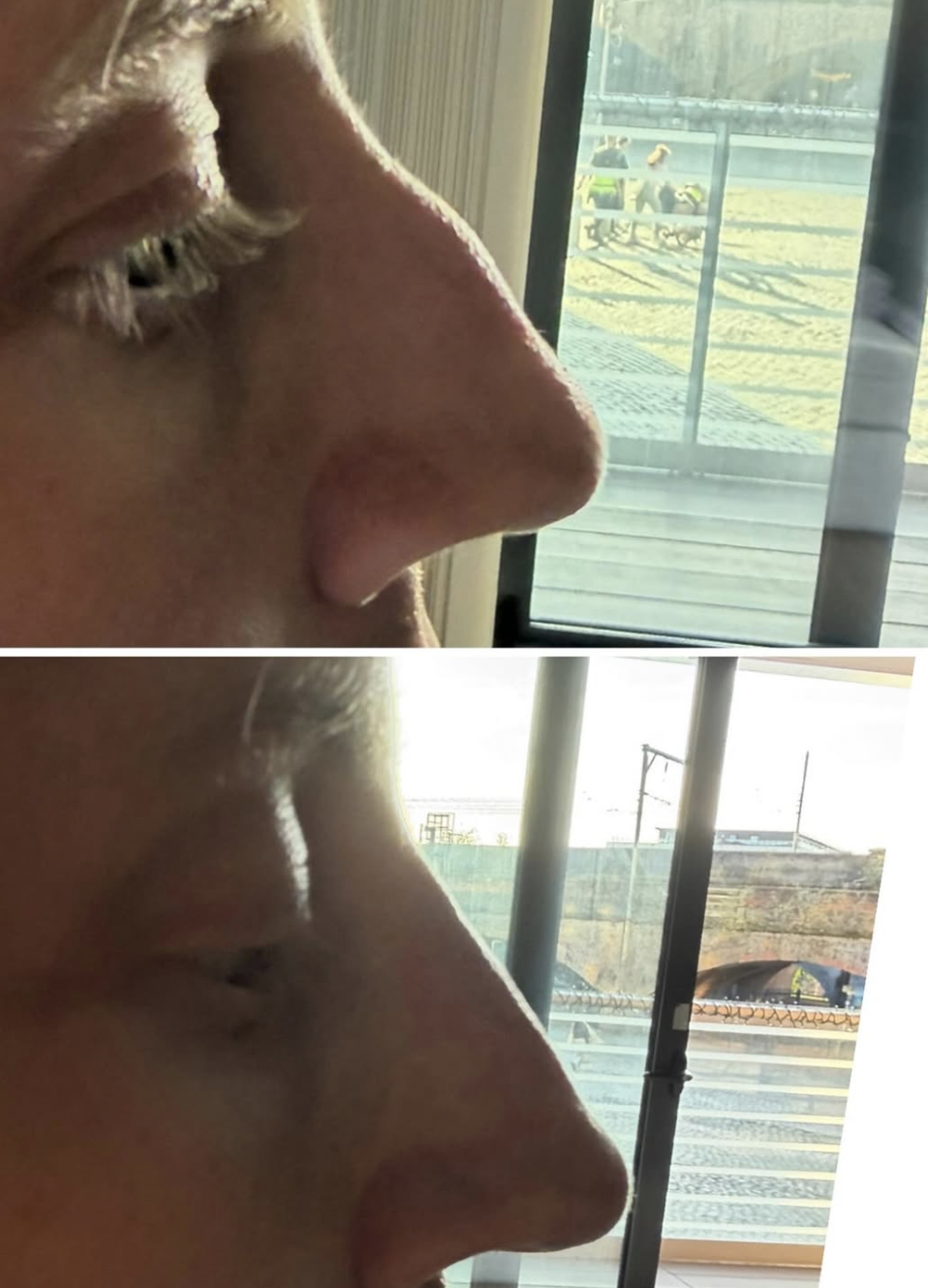 Non-surgical rhinoplasty result